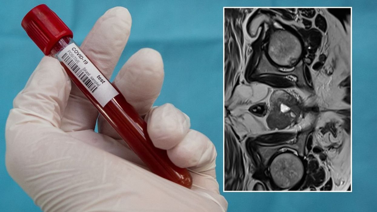 BLOOD VIAL AND PROSTATE SCAN