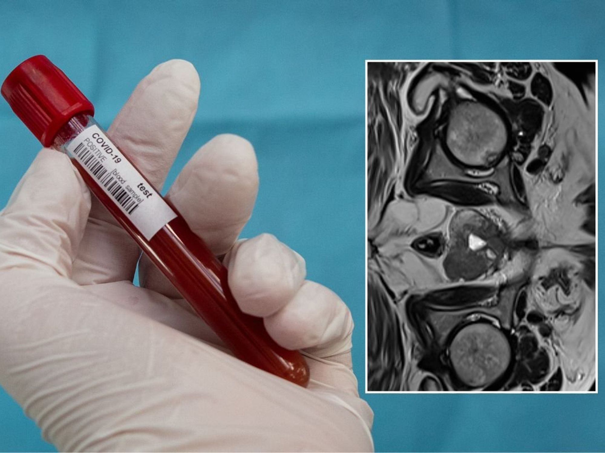 BLOOD VIAL AND PROSTATE SCAN