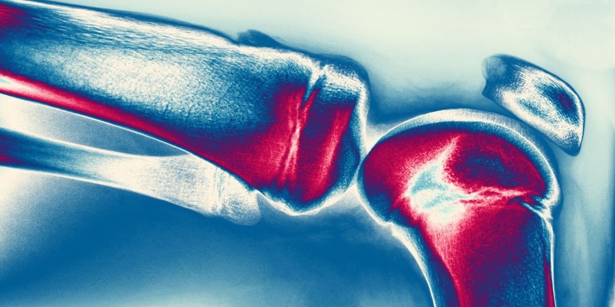 Shortened sleep linked to notably higher risk of joint damage Shortened sleep linked to notably higher risk of joint damage