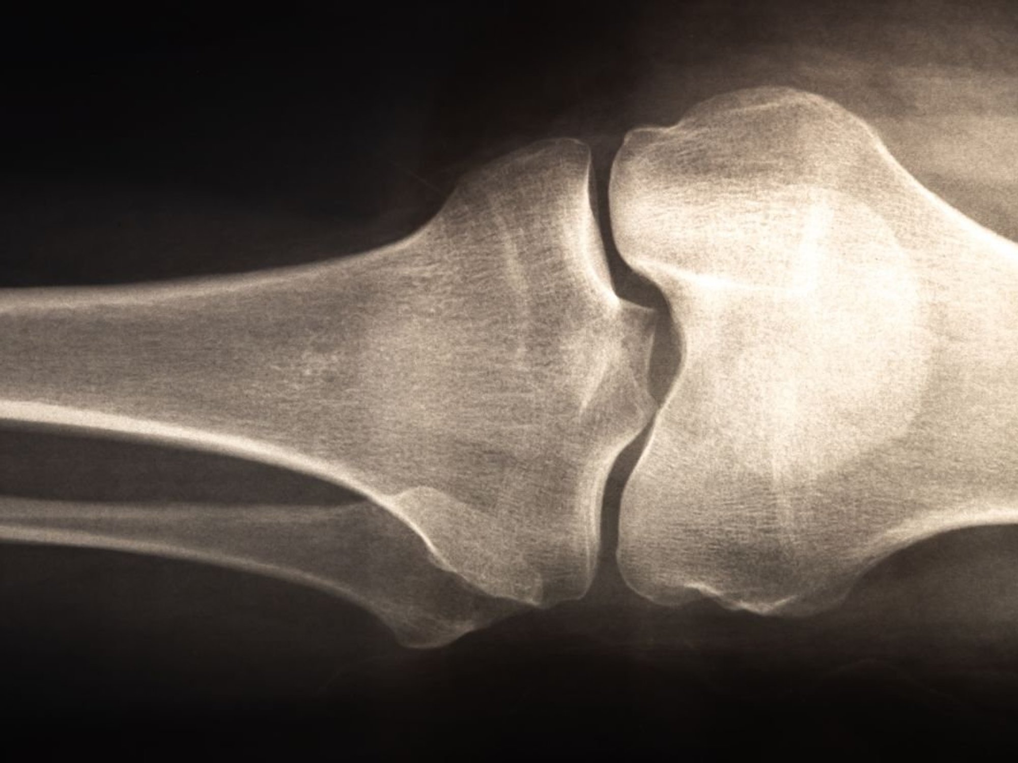 BONE X-RAY