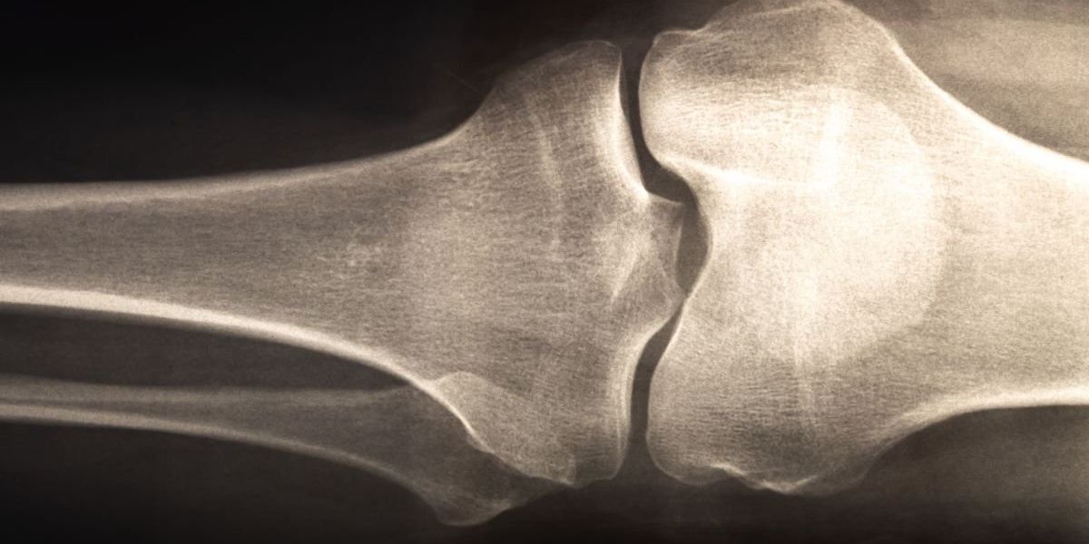 Age-old diet linked to lower risk of bone fractures in study Age-old diet linked to lower risk of bone fractures in study