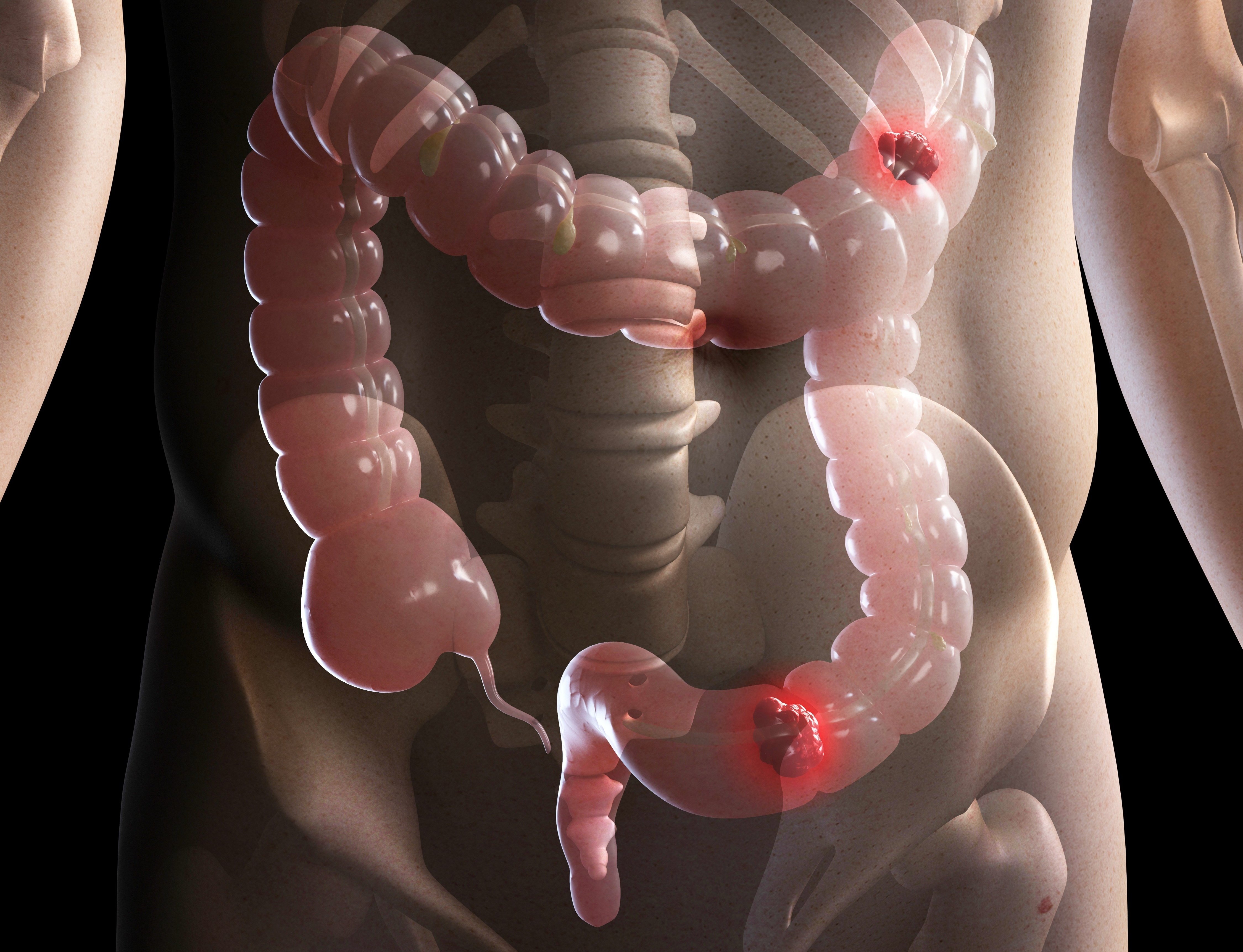 BOWEL CANCER COMPOSITE