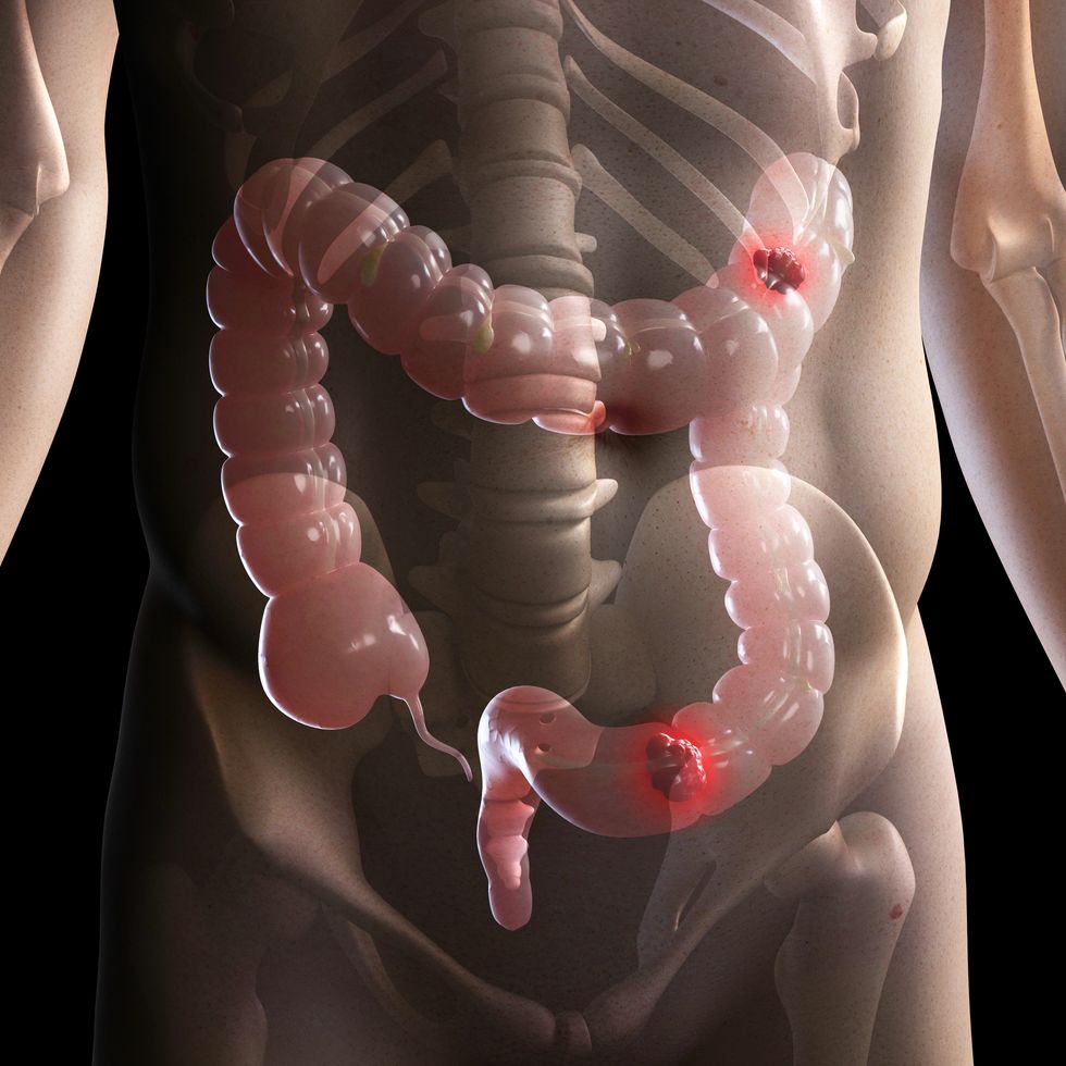 BOWEL CANCER COMPOSITE
