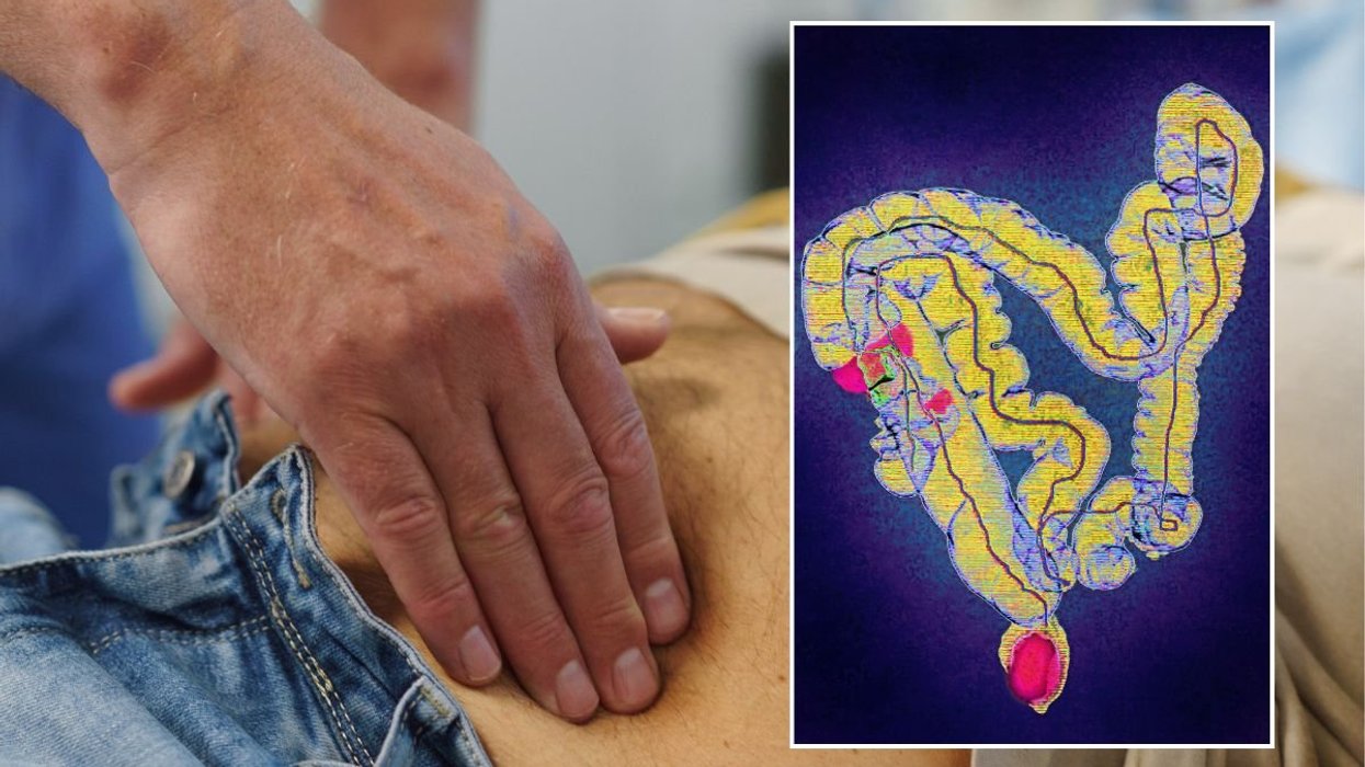 BOWEL CANCER SCREENING