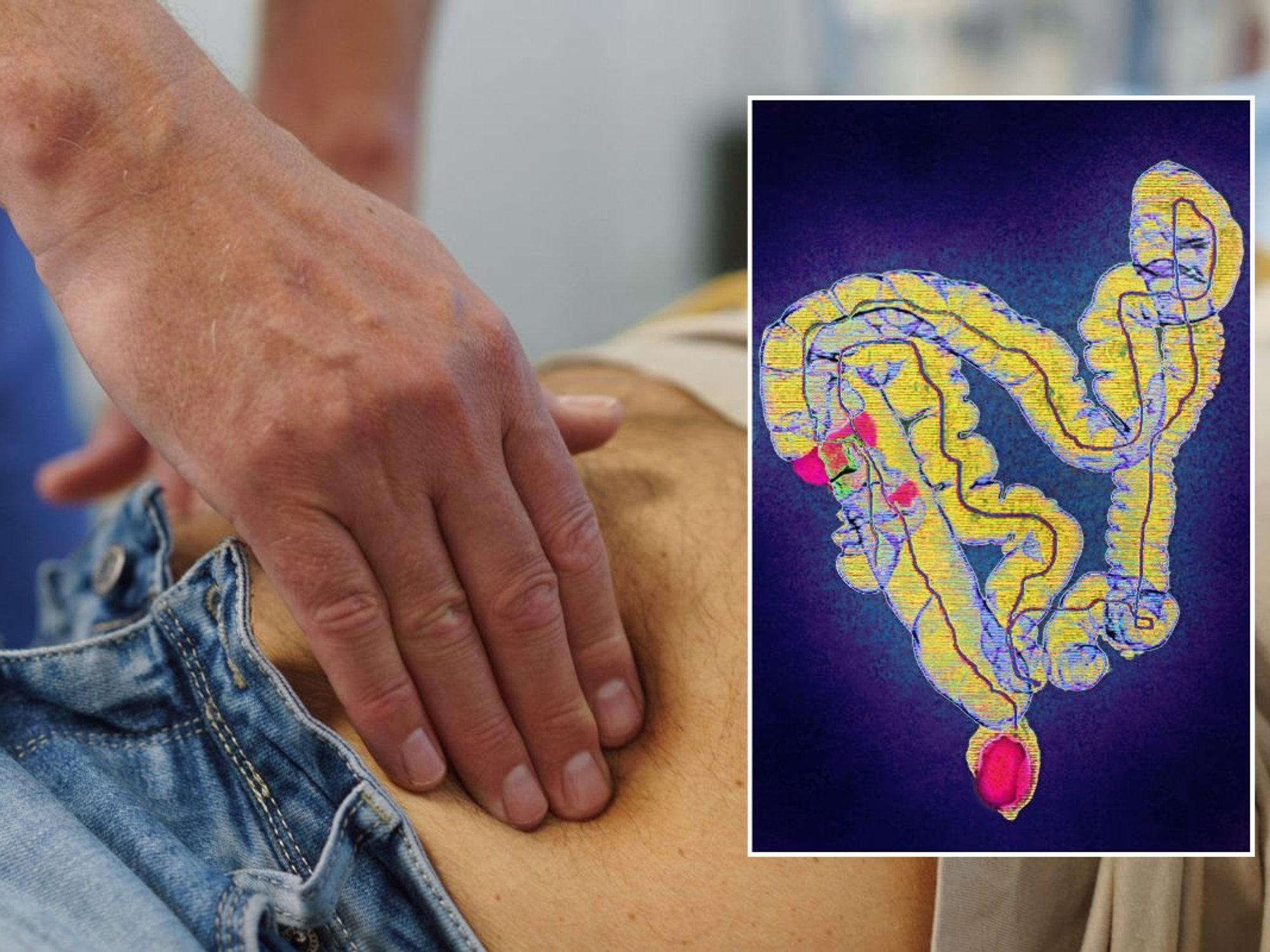 BOWEL CANCER SCREENING