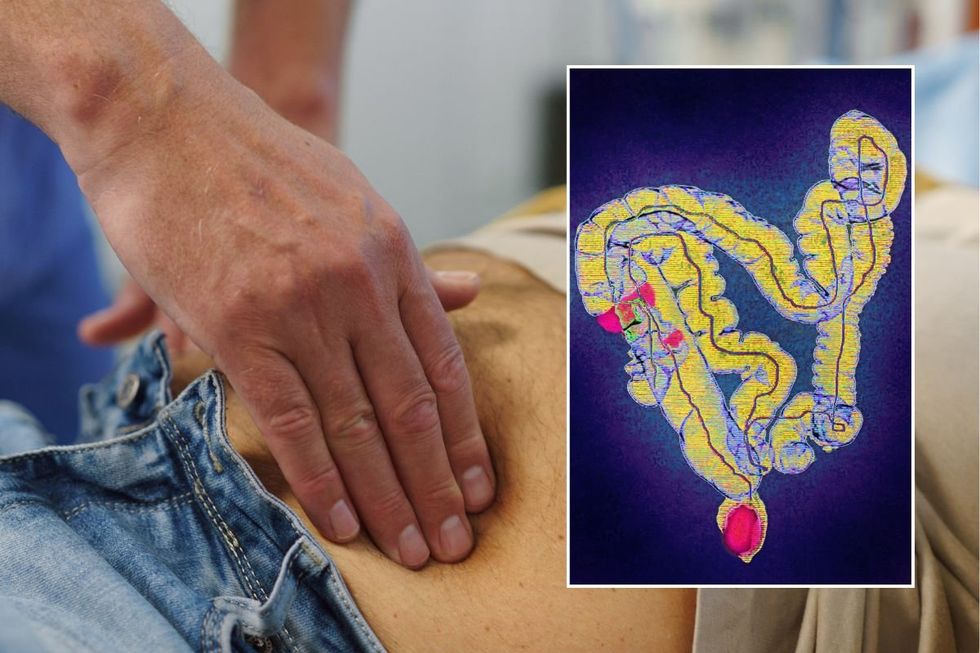 BOWEL CANCER SCREENING