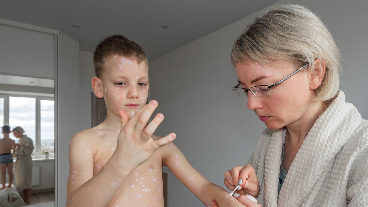 Boy with measles