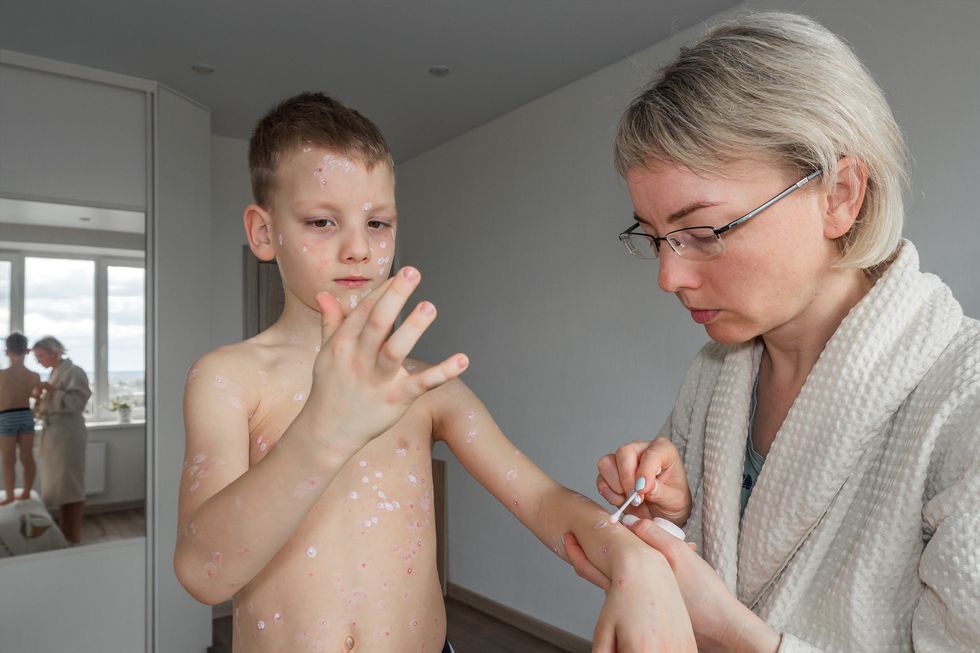 Boy with measles