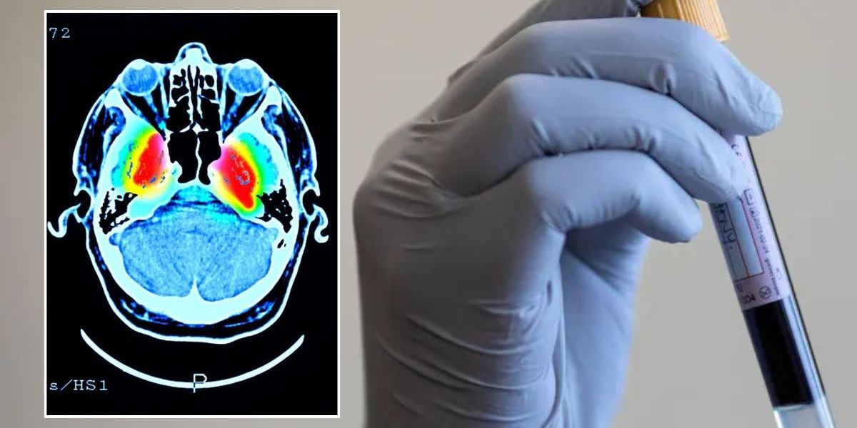NextImg:Dementia breakthrough: Blood test could predict disease in sleep disorder patients 4 years before symptoms appear