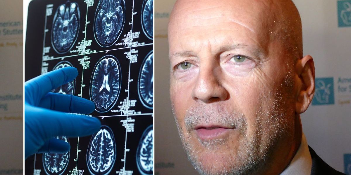 NextImg:Frontotemporal dementia symptoms explained as Bruce Willis's wife shares update - 'His brain is failing him'