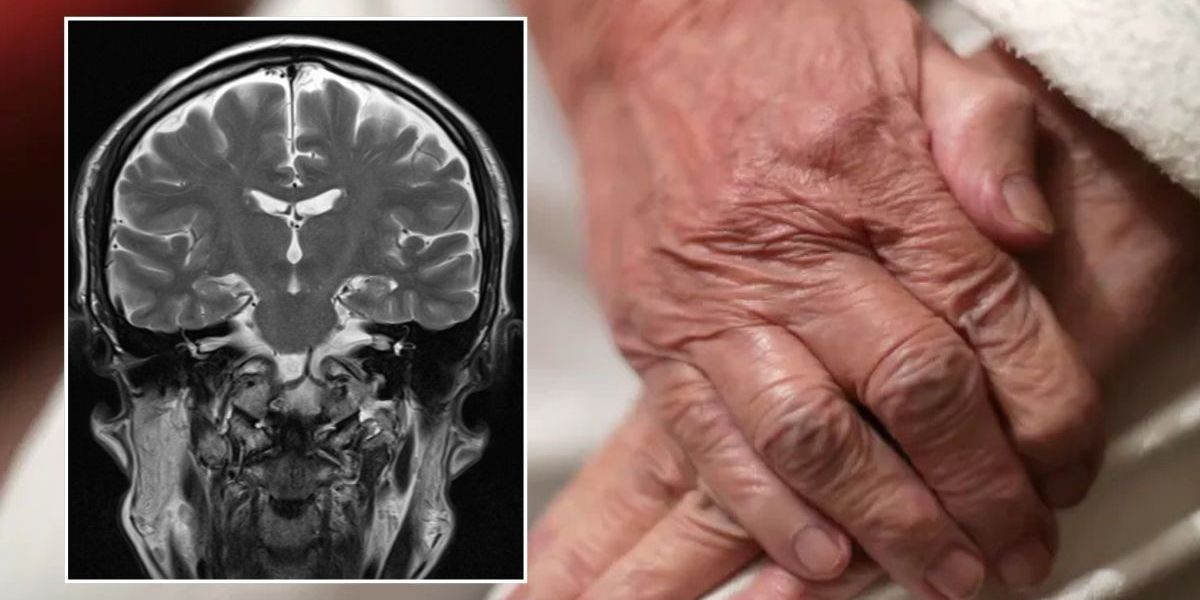 NextImg:Dementia warning: Scientists issue alert over alarming sign in women that could double their risk