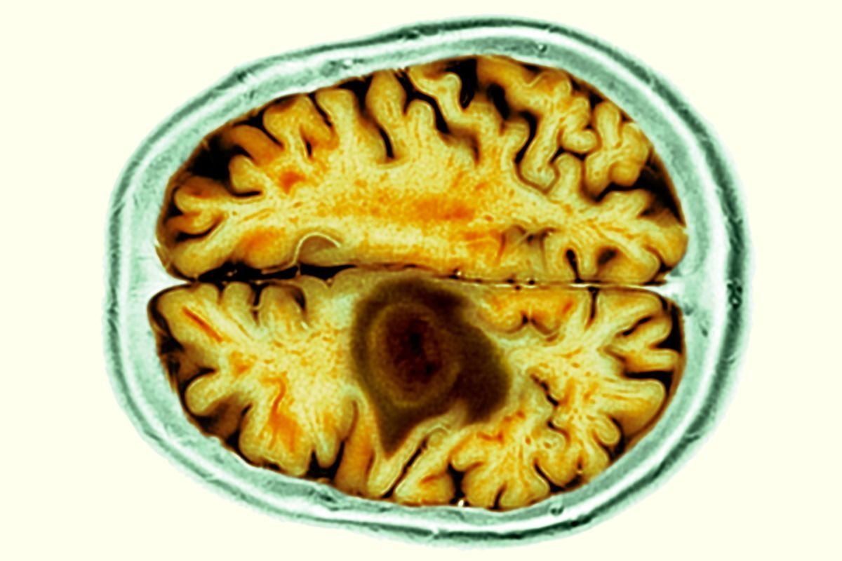 BRAIN SCAN MRI STOCK IMAGE
