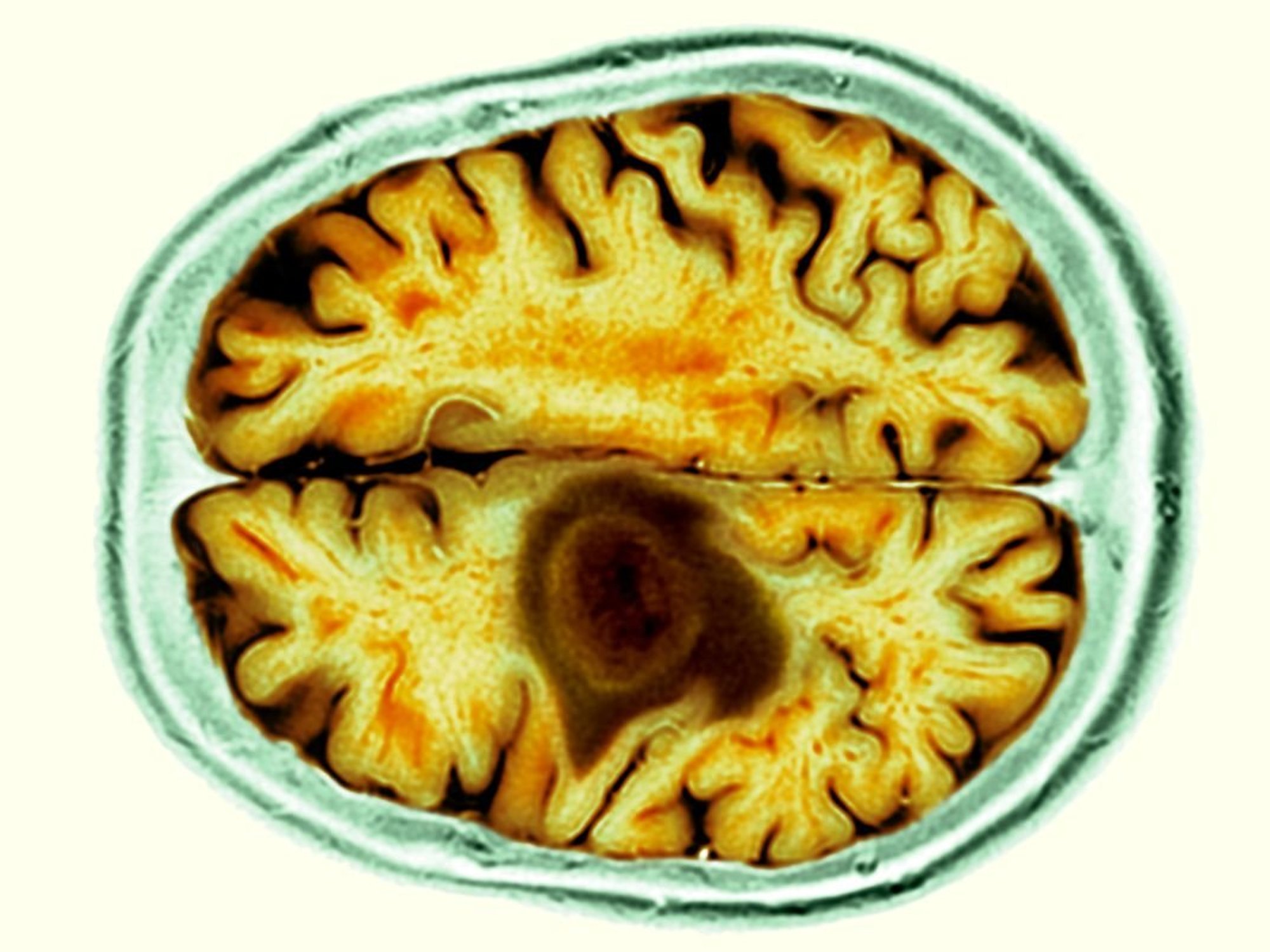 BRAIN SCAN MRI STOCK IMAGE