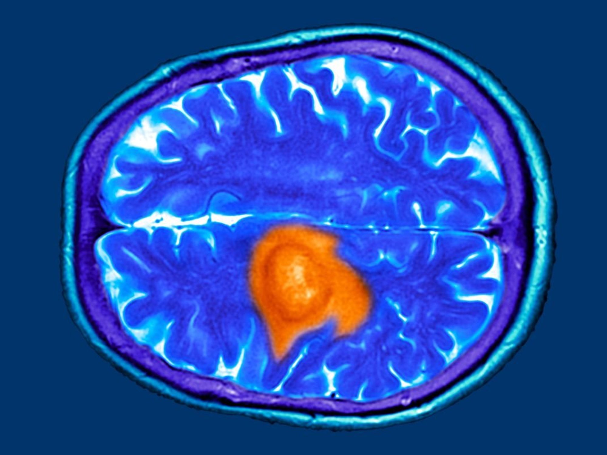 Brain scan MRI