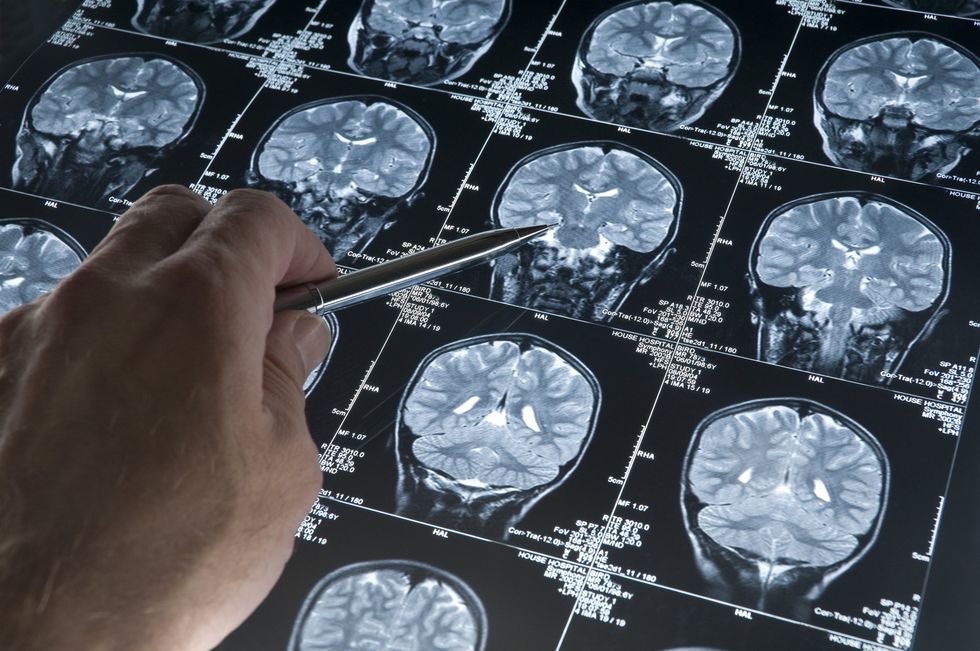 Brain scan stock image