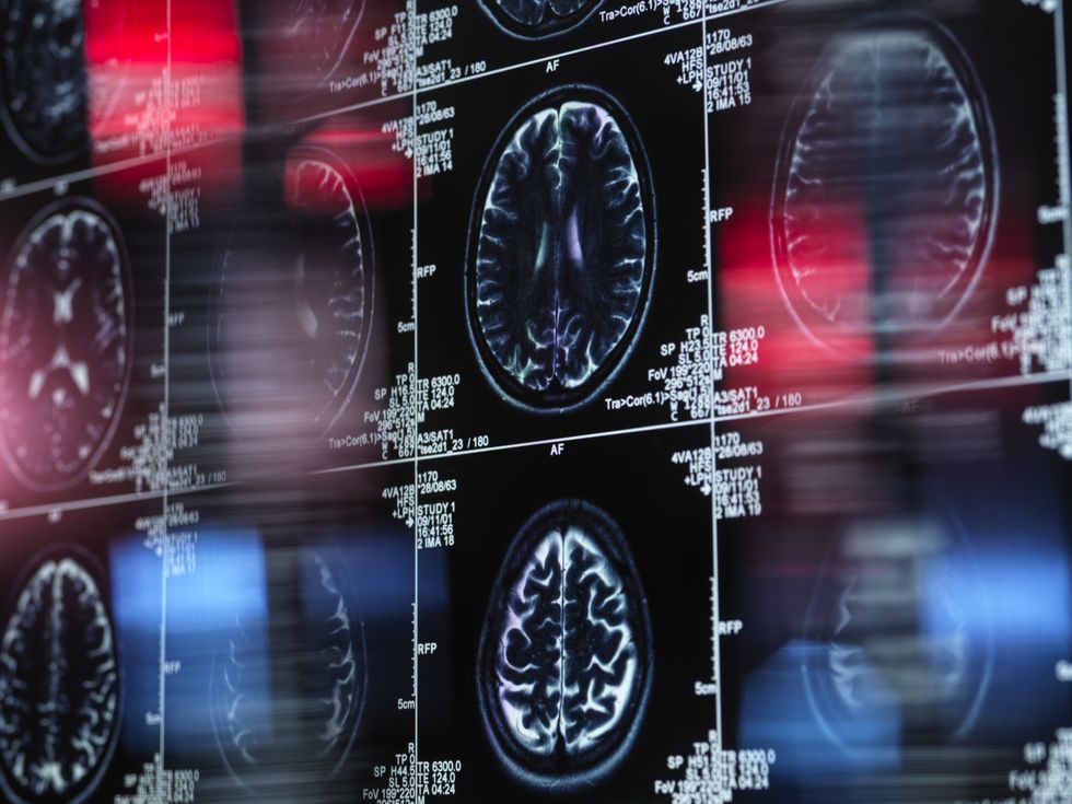 Brain scan
