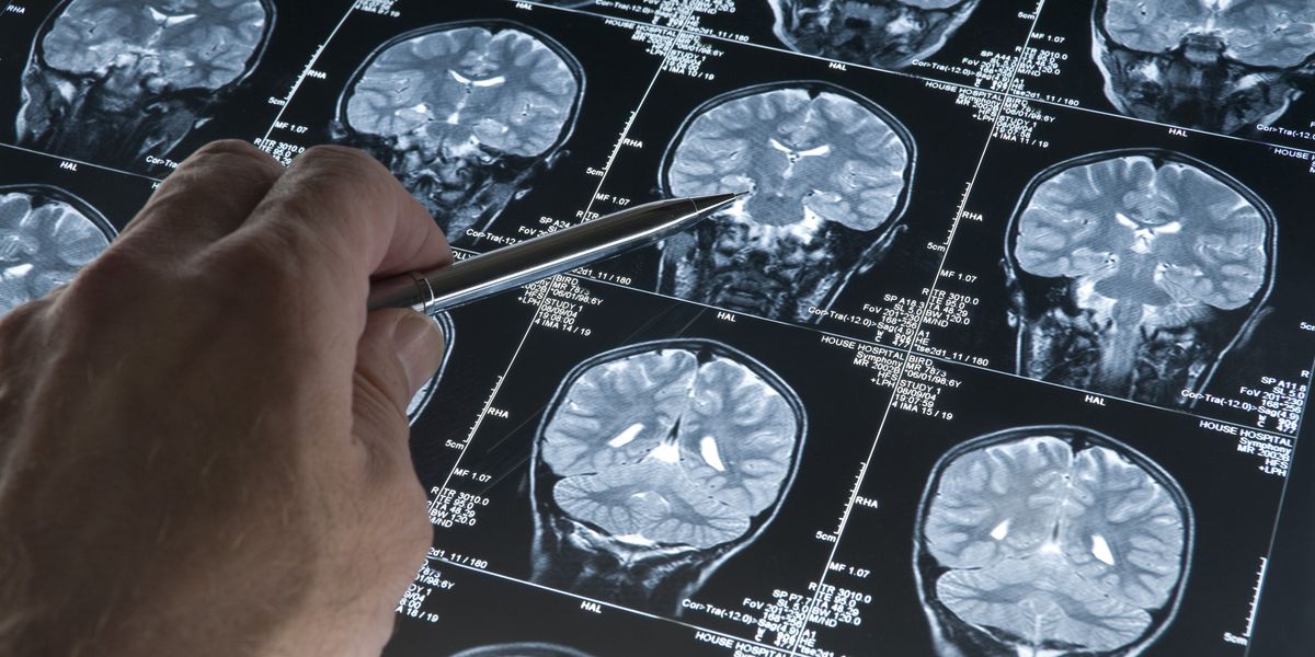 NextImg:Huntington's disease: Scientists celebrate 'breathtaking' treatment that slows progression by 75%