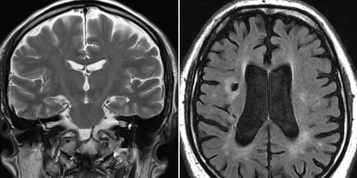 Stroke survivor, 63, shares bizarre symptom doctors warn many people would miss Stroke survivor, 63, shares bizarre symptom doctors warn many people would miss