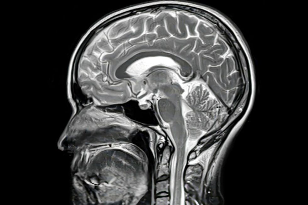 Brain scan