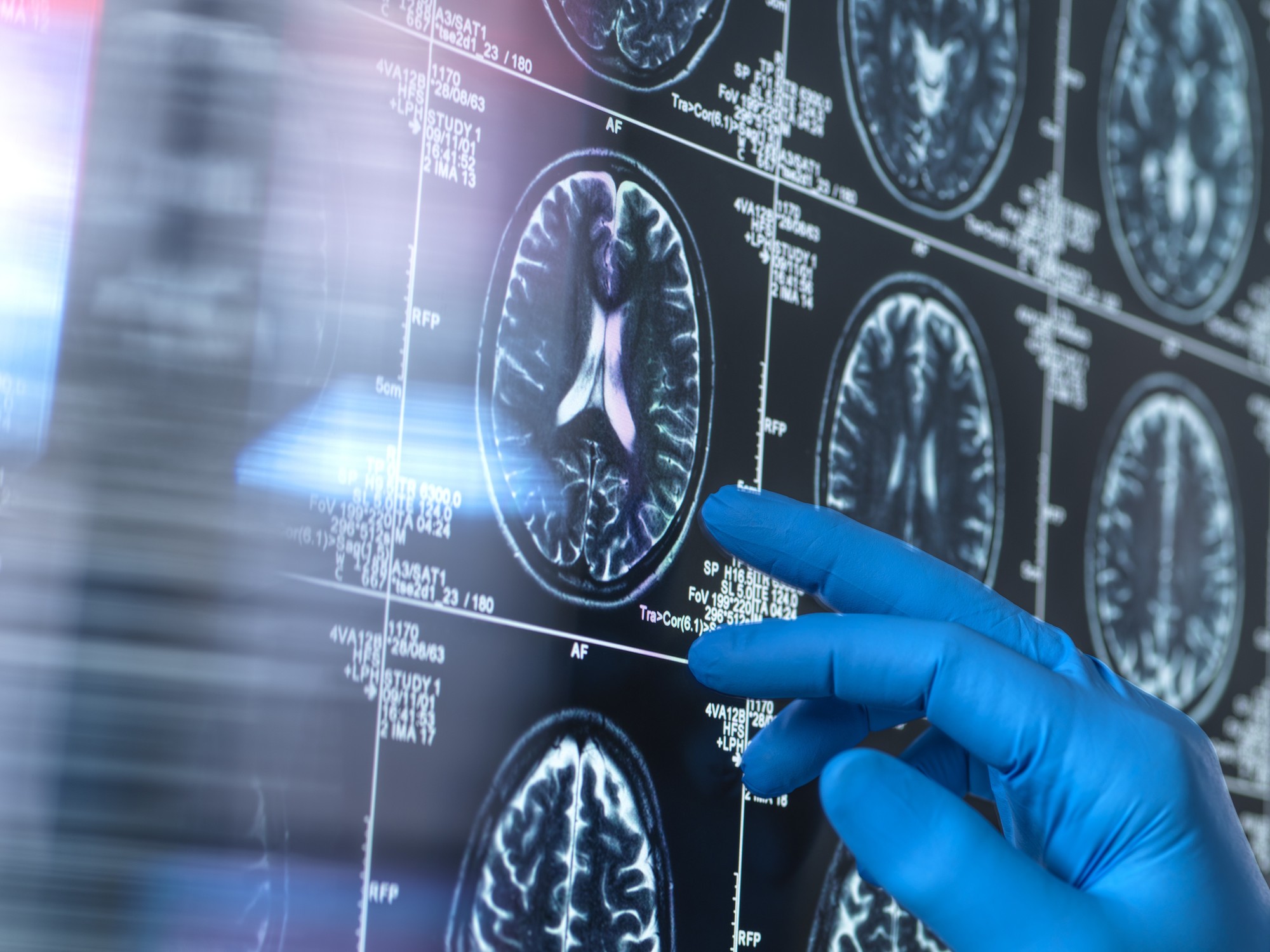 Live Longer MIND Diet May Reduce Dementia Risk Live longer mind diet may reduce dementia risk
