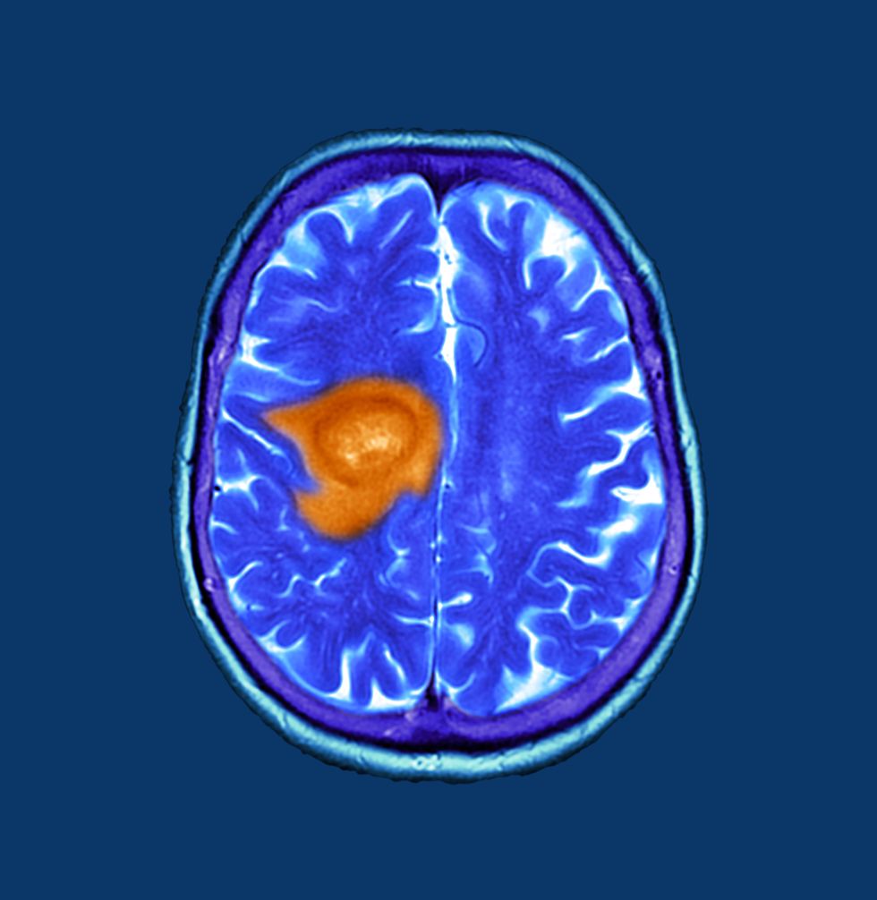 brain tumour composite
