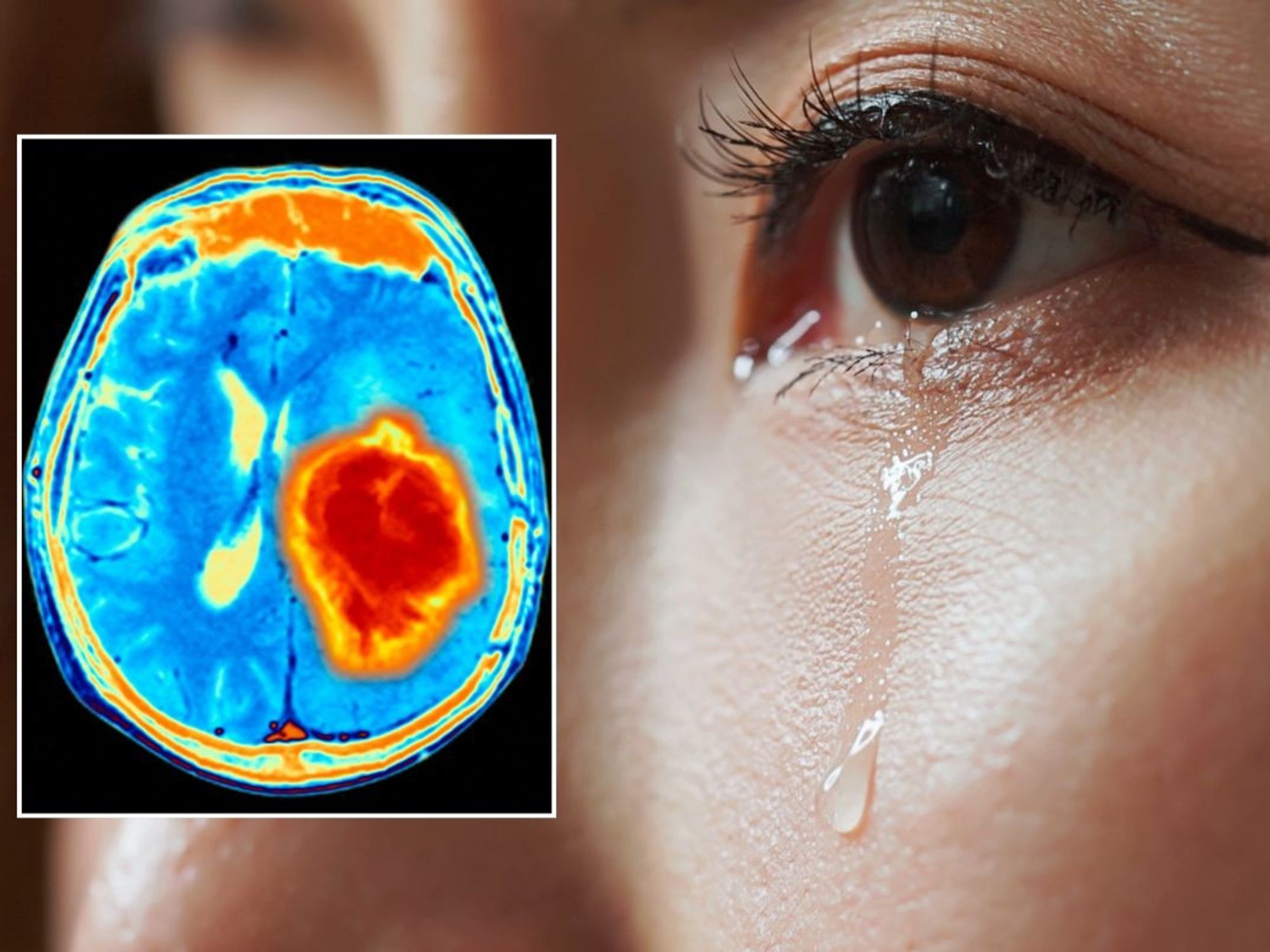 BRAIN TUMOUR