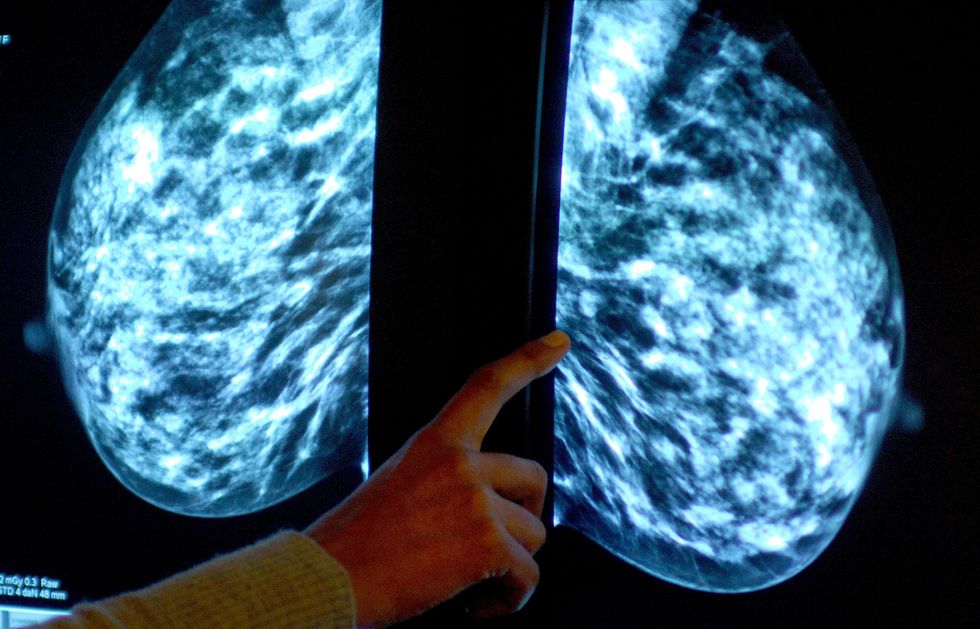 BREAST CANCER SCREENING