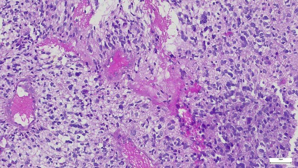 Cancer cells under microscope