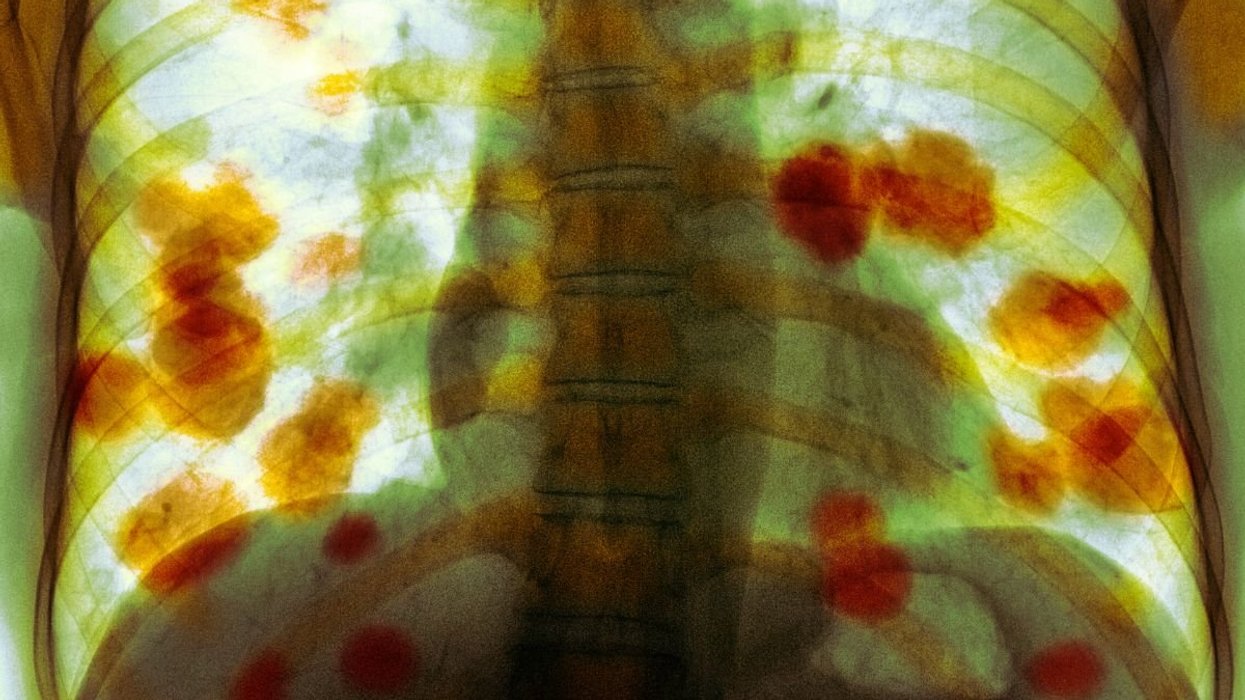 CANCER SCAN