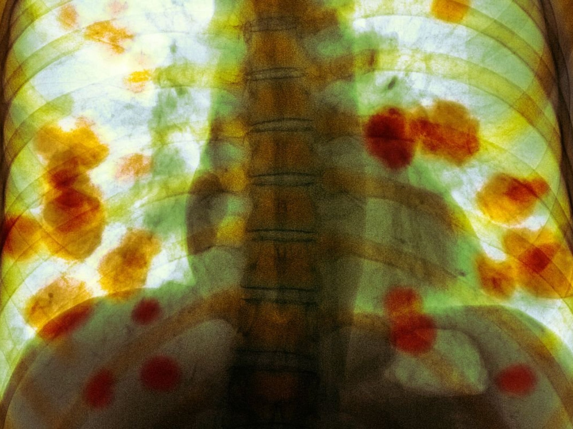 CANCER SCAN