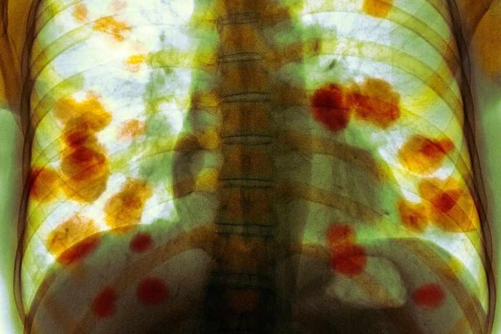 CANCER SCAN