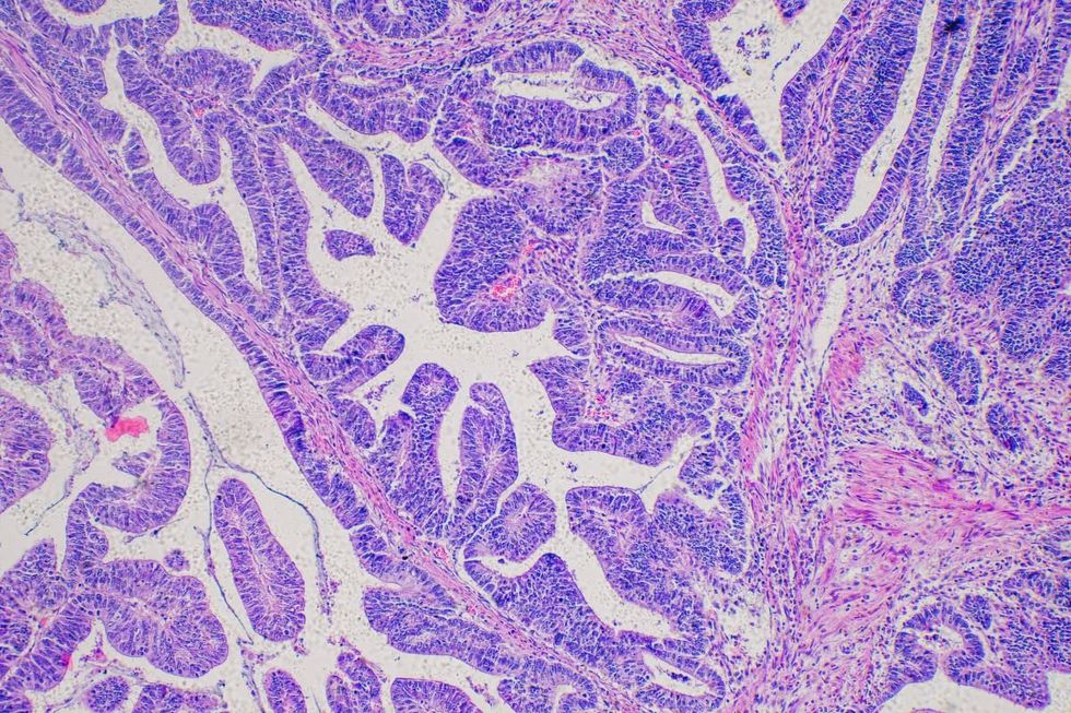 CANCER SCAN