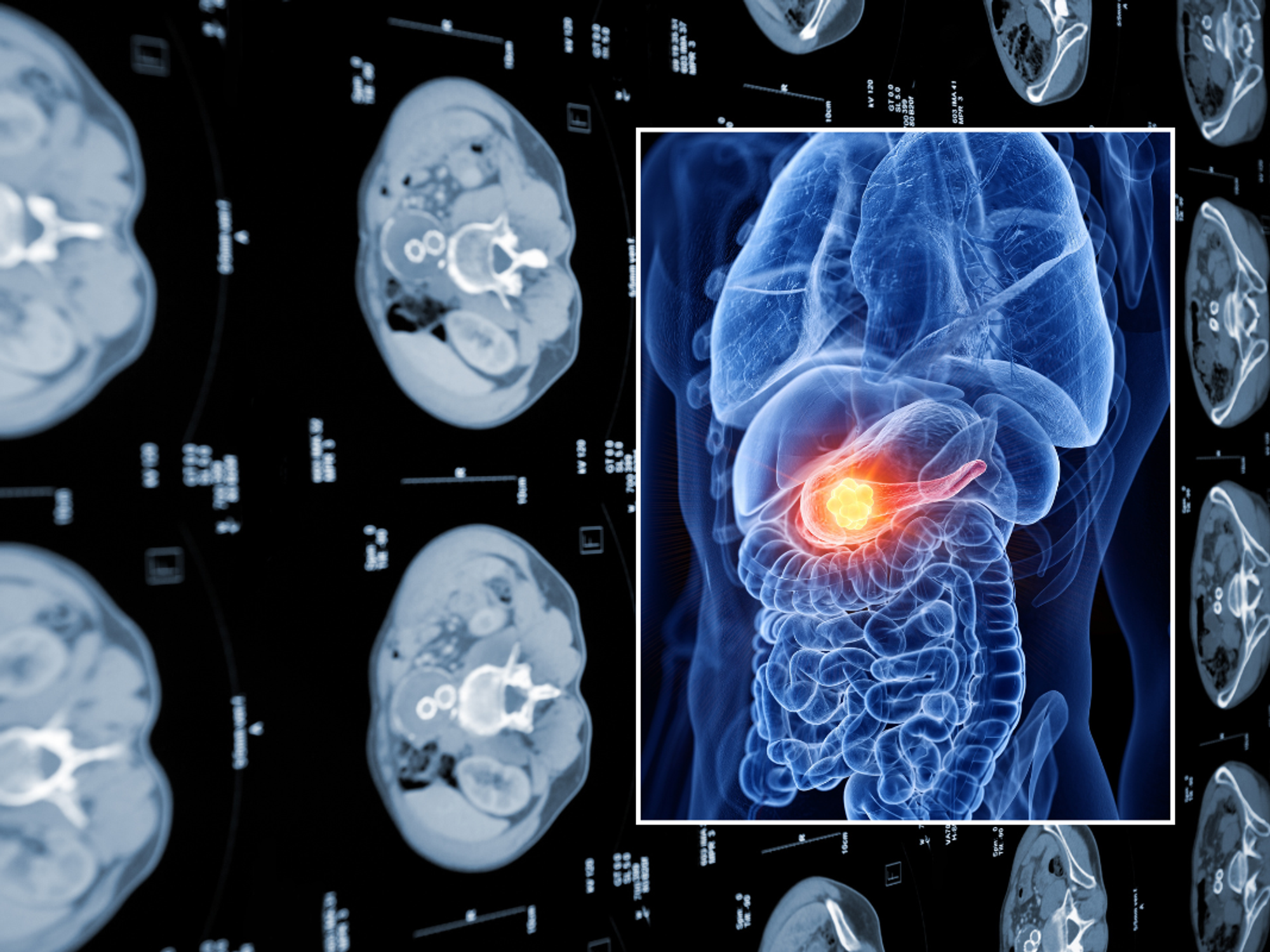 CAT scan of human abdomen; pancreatic cancer illustration