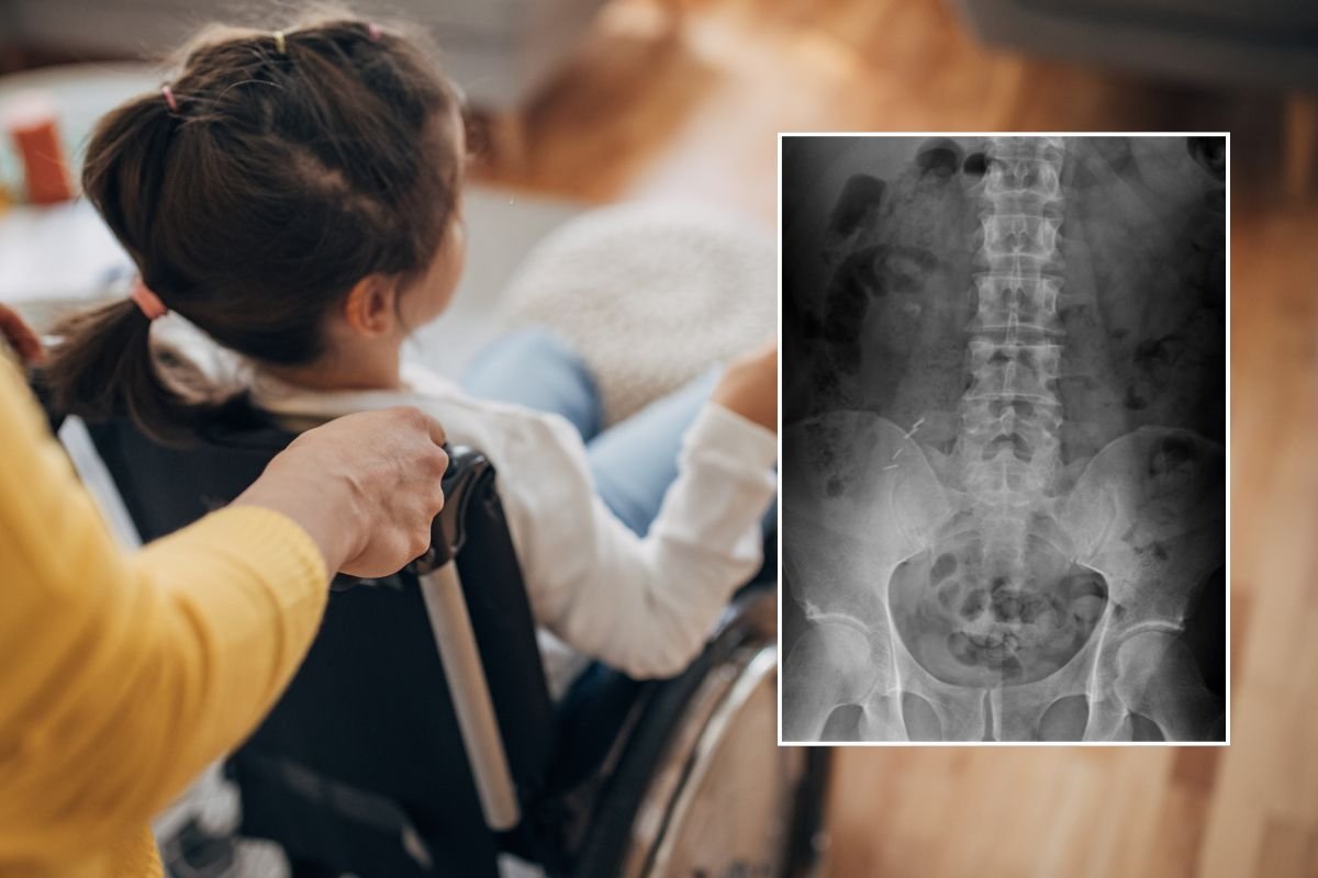 child in wheelchair and spinal x-ray