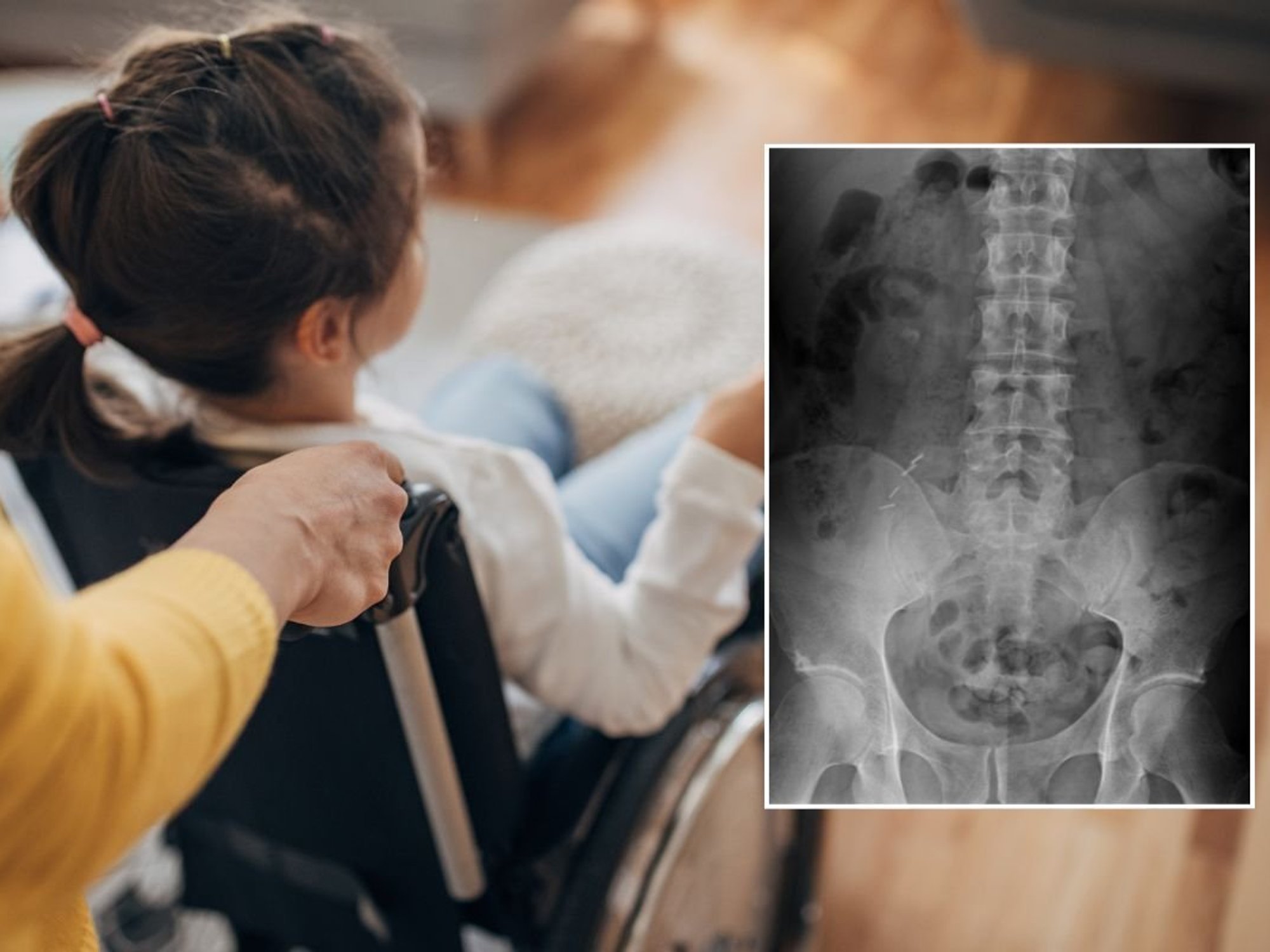 child in wheelchair and spinal x-ray