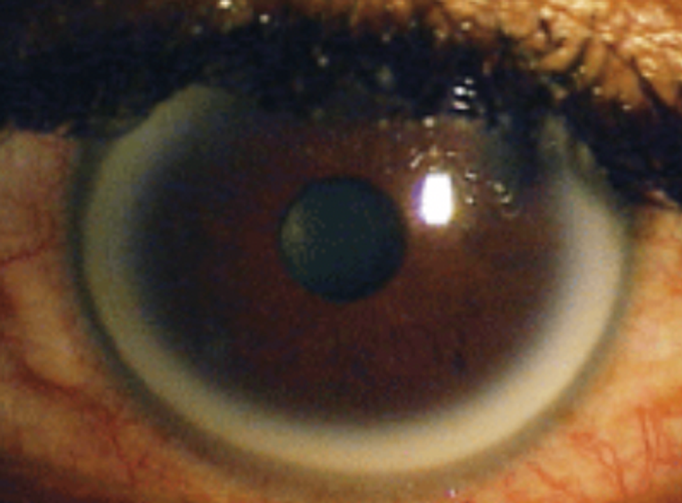 Cholesterol deposits in the eye