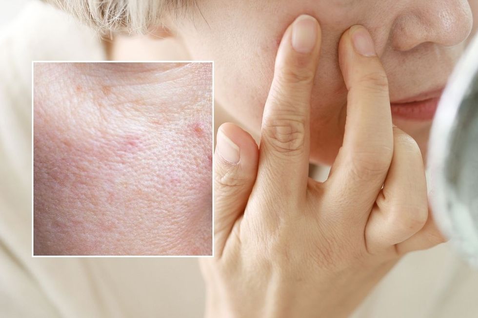 CLOSE UP OF FACIAL PORES