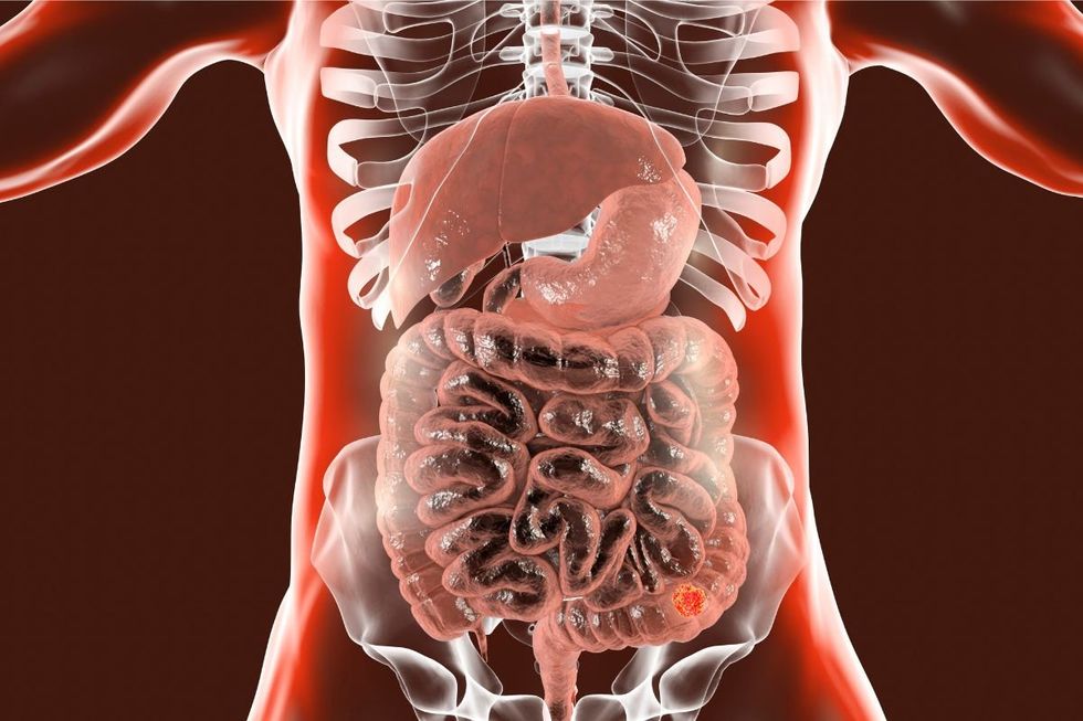 colon cancer illustration