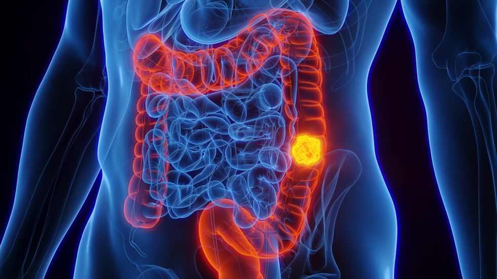 Colon cancer in the body illustration