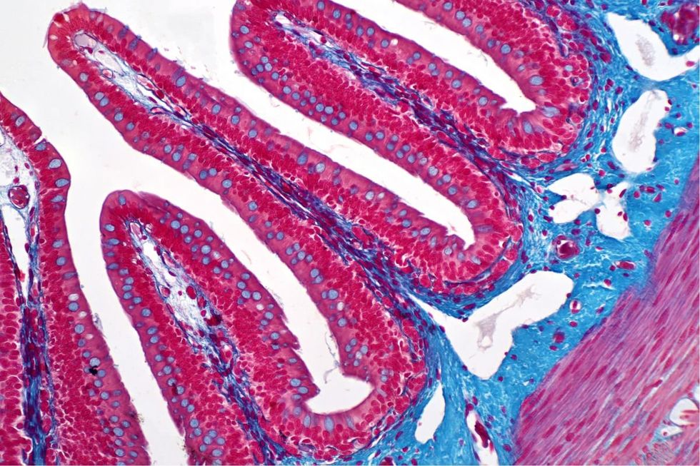 COLON CANCER UNDER MICROSCOPE