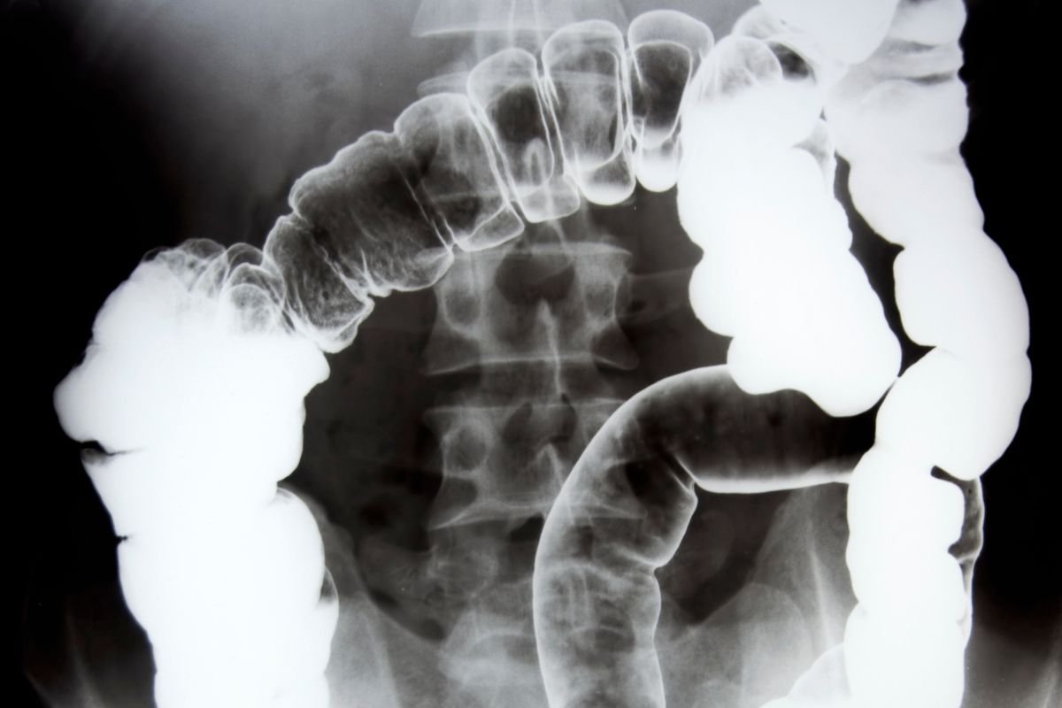 colon scan