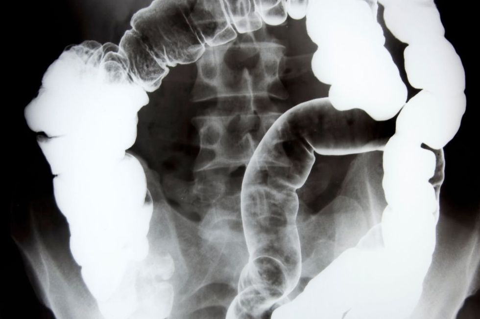 COLON X-RAY