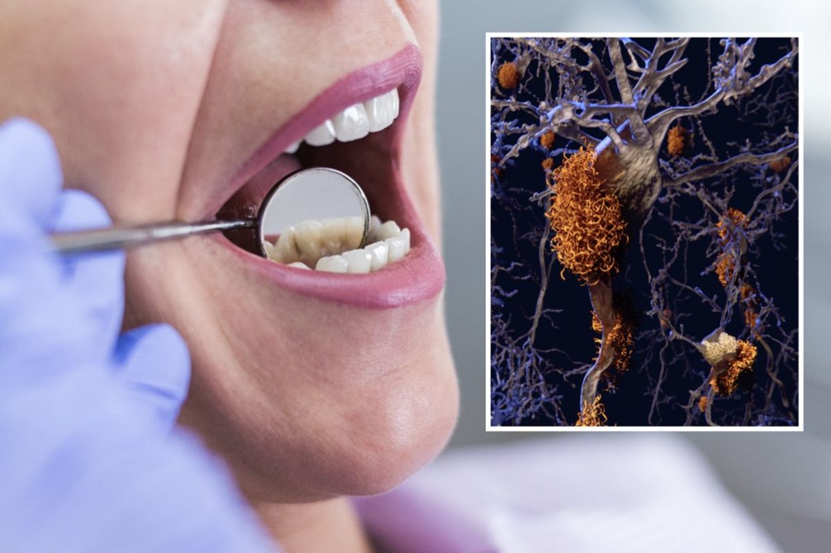 Composite image a woman getting a dental check-up and Alzheimer's plaques in the brain 