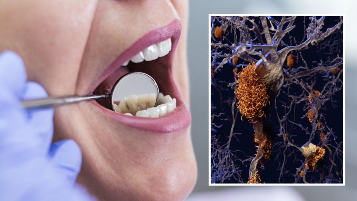 Composite image a woman getting a dental check-up and Alzheimer's plaques in the brain