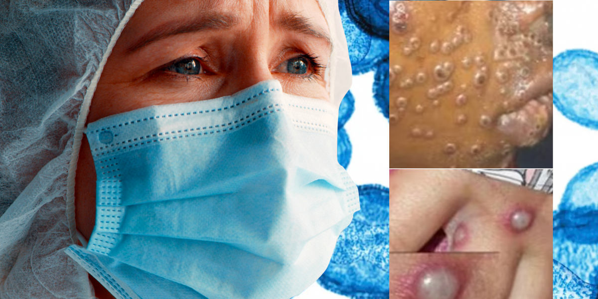 NextImg:'Pay attention!' Virologist warns new strain of mpox 'likely' spreading in the UK is '10 times more deadly'