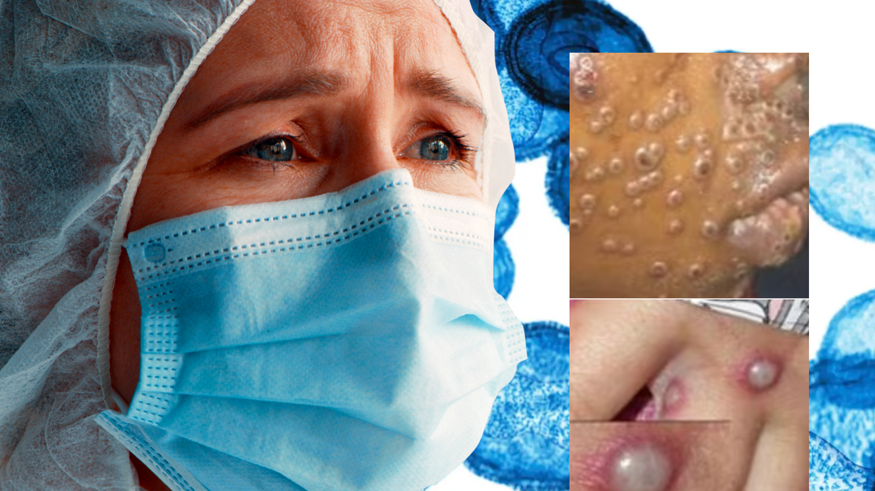 composite image of a concerned surgeon in a face mask (left) and mpox symptoms (right)