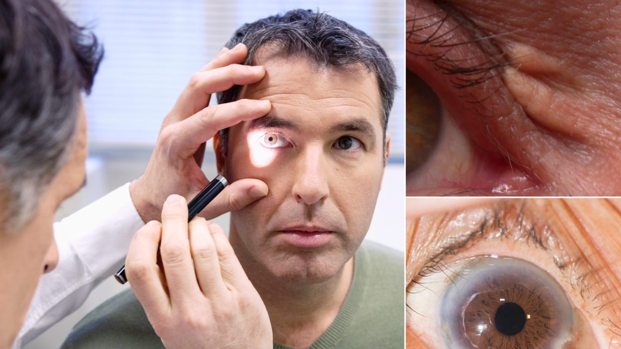 Composite image of a doctor studying a person's face and clumps of cholesterol in and around an eye