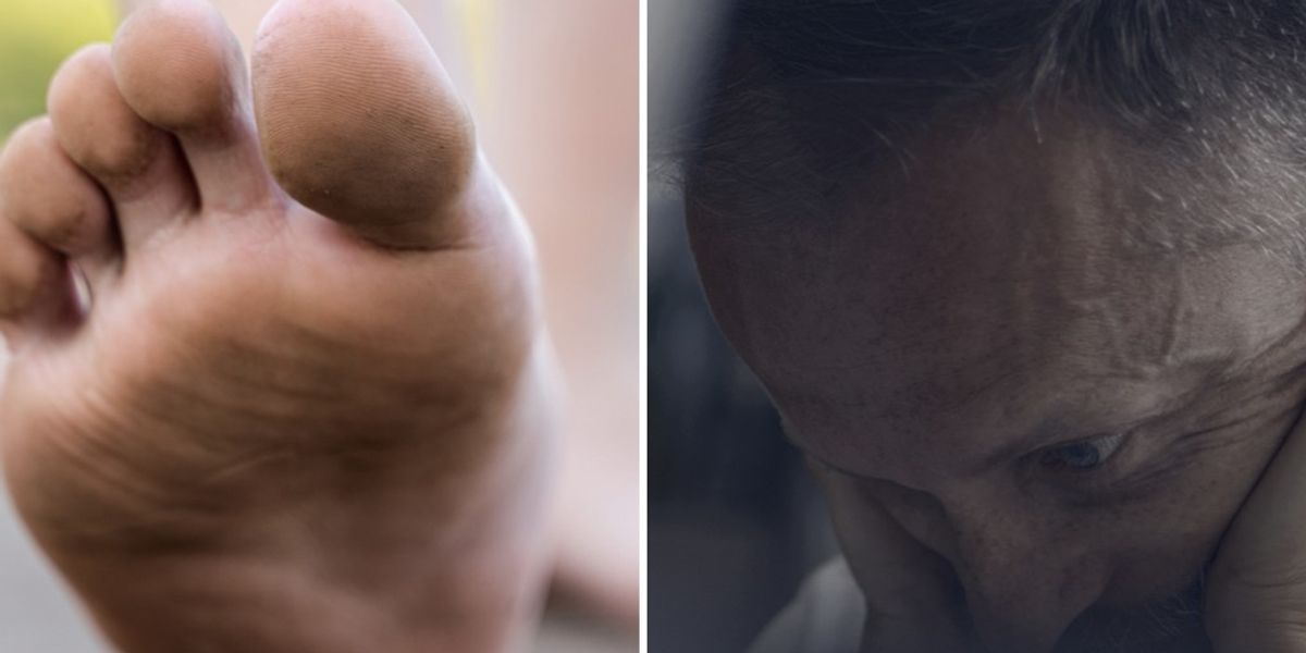 B12 Deficiency Symptoms Include Burning Foot b12-deficiency-symptoms-include-burning-foot