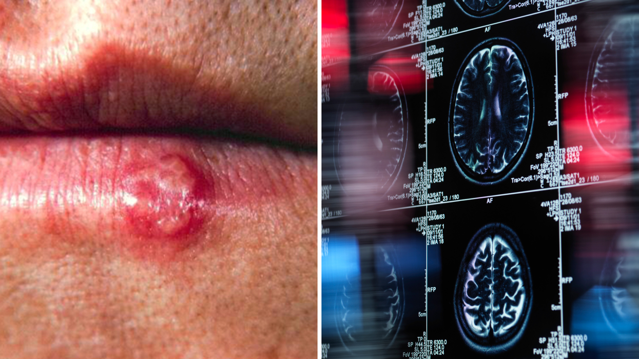 Composite image of a mouth virus next to a brain scan