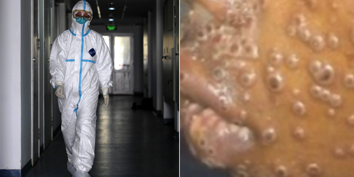 NextImg:WHO issues major update on mpox outbreak after first case in Europe sparks pandemic fears: 'Critical test'